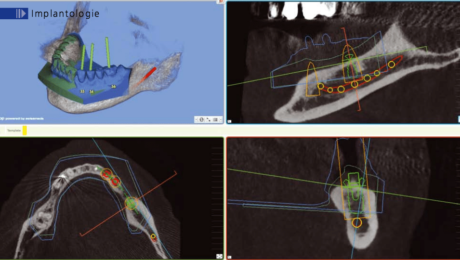 implanthologie_dentaire